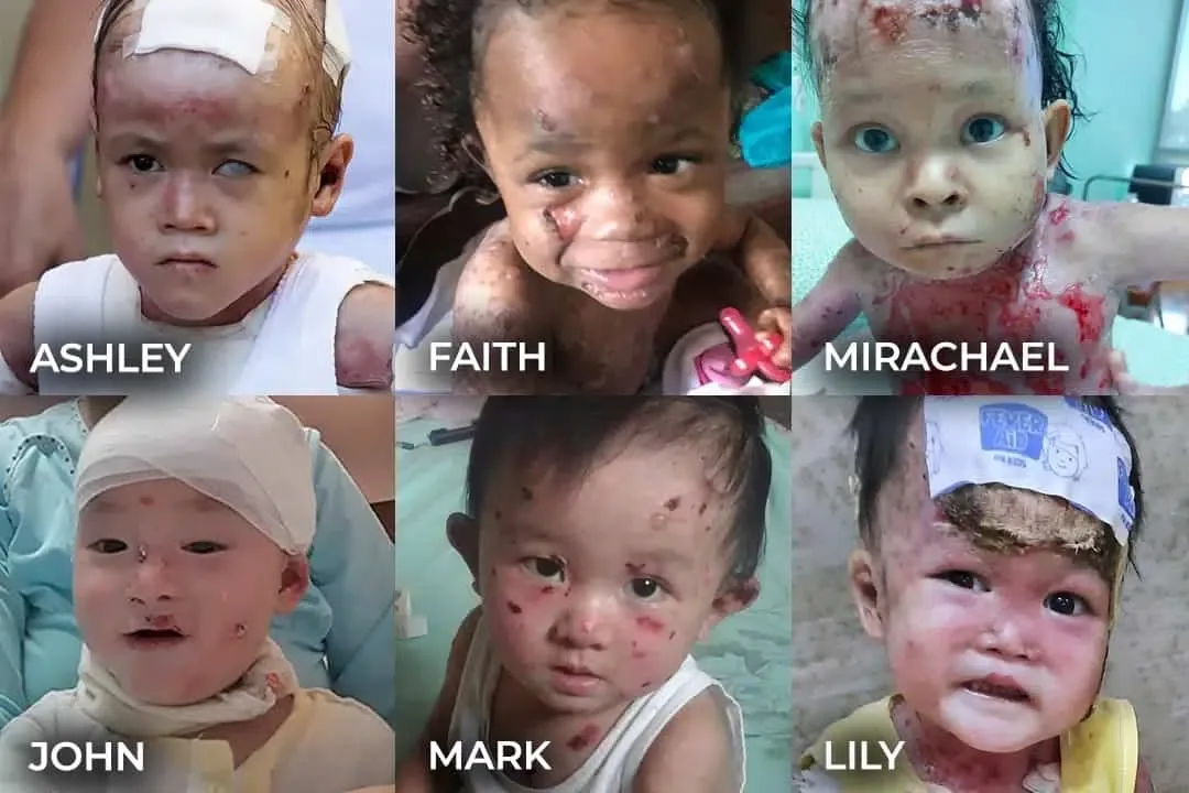 12 Children Need Immediate Treatment