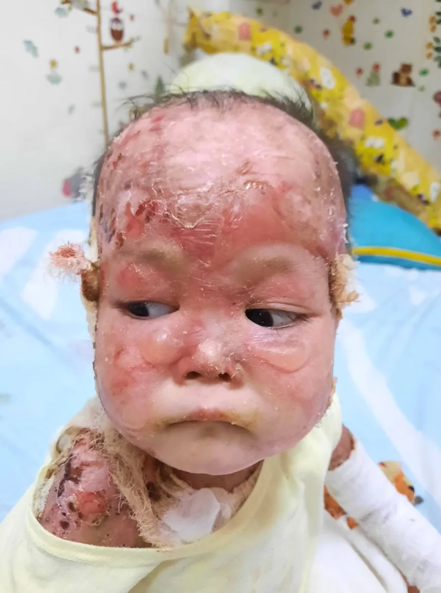 Donor Impact Report: Sofia's Progress Through EB Treatment