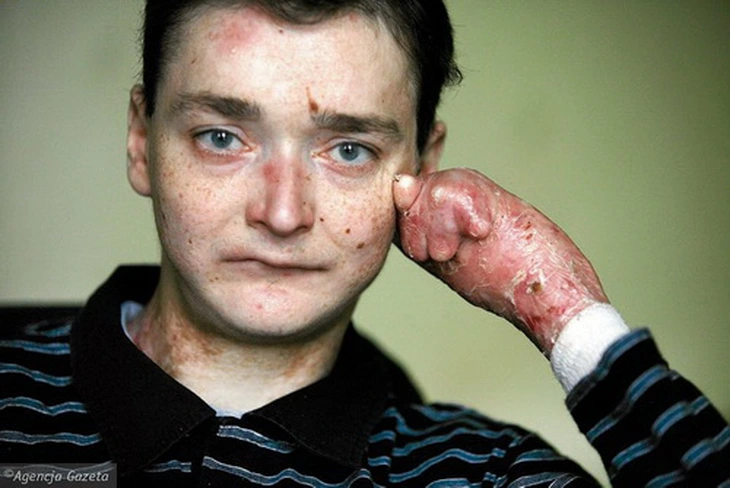 What is Epidermolysis Bullosa?