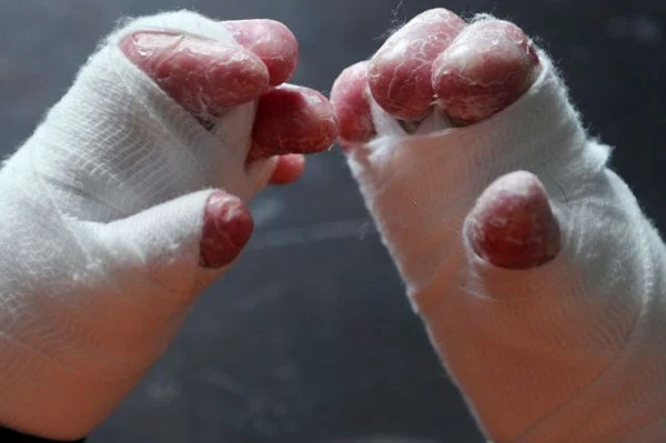 What is Epidermolysis Bullosa?