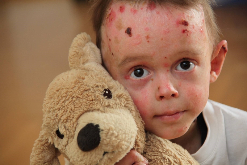 What is Epidermolysis Bullosa?
